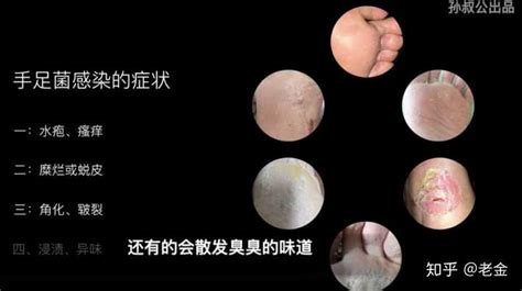 美浮特治療腳氣能斷根嗎,美浮特治腳氣有副作用嗎縮略圖