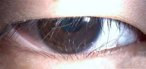 眼睫毛根部很癢是怎么回事,眼睫毛根部很癢是怎么回事用啥藥縮略圖
