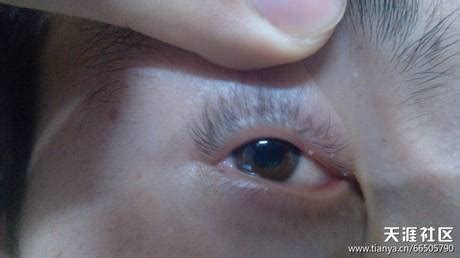 眼睫毛長陰虱的圖片(眼睫毛陰虱怎么去除)縮略圖