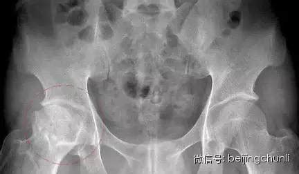 黃瓜籽對股骨頭壞死功效與作用,股骨頭壞死吃黃瓜籽管用嗎縮略圖