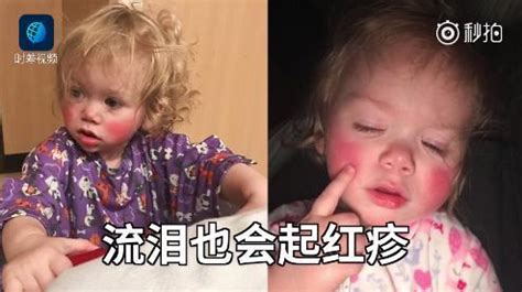 消毒水過敏,消毒水過敏怎么辦縮略圖