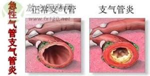 氣管炎的癥狀(氣管炎的癥狀和表現(xiàn))縮略圖