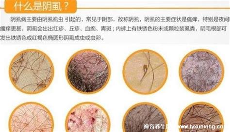 被子上的陰虱怎么去除,陰虱是什么原因得的縮略圖