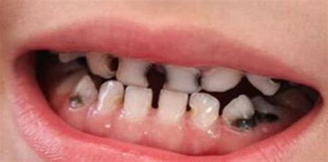 奶瓶齲(奶瓶齲齒怎么治療)縮略圖
