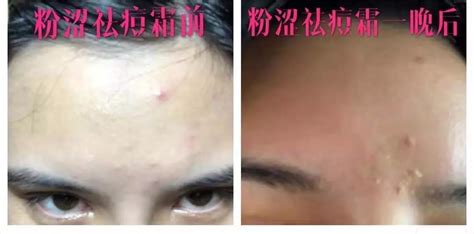 珍珠粉可以祛痘嗎(珍珠粉可以祛痘嗎女生)縮略圖