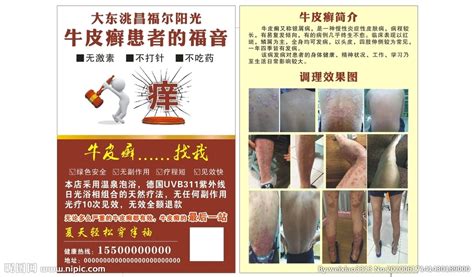 傳單病,傳單病毒感染是如何引起的縮略圖