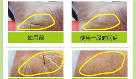 皮鞭抽打皮膚開裂(皮鞭抽打痕跡怎樣消除)縮略圖