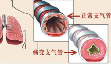 氣管炎(氣管炎的癥狀和表現)縮略圖