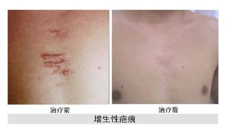 手術刀口疤痕增生癢怎么辦(手術刀口疤痕增生癢用什么藥膏)縮略圖