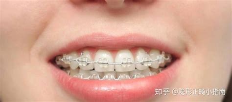 隱形牙套和鋼絲牙套哪個效果更好,鋼絲牙套和隱形牙套效果哪個好縮略圖