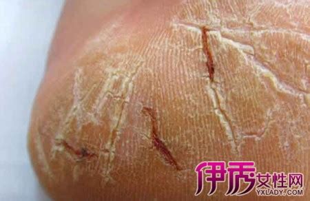 尿素霜治什么皮膚病,尿素霜治療什么皮膚病最有效縮略圖