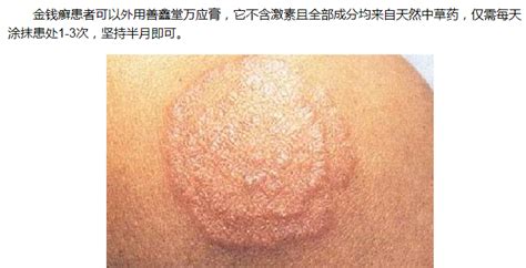 銅錢癬(銅錢癬圖案)縮略圖