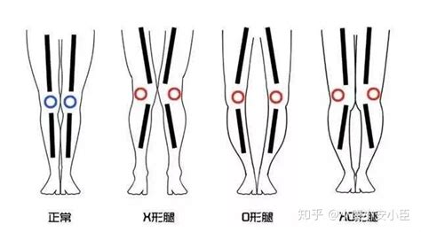 學步車真的會變O型腿嗎,學步車真的會變o型腿嗎視頻縮略圖