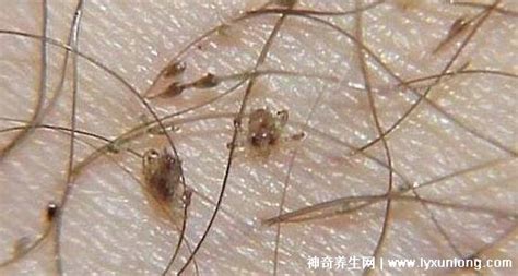 被褥上的陰虱怎么去除,陰虱蓋過的被子會傳染嗎縮略圖