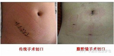 手術刀口一般多久愈合(手術刀口一般多久愈合正常)縮略圖