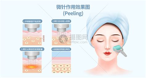 海綿微針的美容功效(海綿微針的美容功效多久用一次)縮略圖