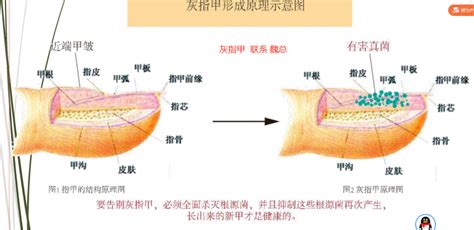 美浮特抗菌凝膠治療疣使用方法(美浮特抗菌凝膠治療疣使用方法視頻)縮略圖
