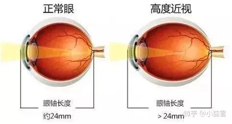 紅光治療眼睛近視有用嗎(哺光儀治療近視利弊)縮略圖