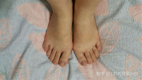 人字拖鞋可以矯正拇指外翻嗎,人字拖可以矯正拇指外翻嗎縮略圖