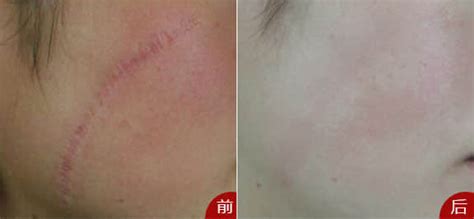 手術刀疤怎么去掉不留痕跡(手術刀疤怎么去掉不留痕跡呢)縮略圖