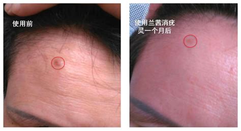 昆布榧子片消疣片,昆布榧子片消疣片功效縮略圖