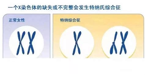 透納氏癥候群,透納氏癥候群一定是女孩嗎縮略圖