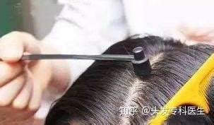梅花針治療皮膚病(梅花針治療皮膚病的用法)縮略圖