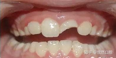 大門牙掉了要多久才能長出來(兩歲寶寶把大門牙掉了一半)縮略圖