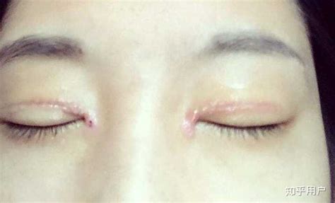 手術刀疤增生怎么去除,刀疤增生怎么消除最快縮略圖