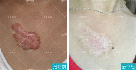 夾板燙傷的疤痕能自愈嗎,卷發棒燙傷的疤痕多久能消退縮略圖