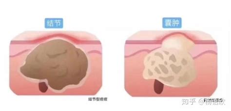 男包皮上有一堆小痘痘(男包皮上有一堆小痘痘怎么回事)縮略圖