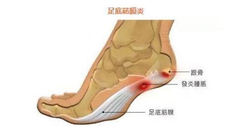 足膜炎的癥狀及治療方法,鵝足炎的癥狀和治療方法縮略圖