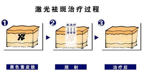 祛斑真的能去掉嗎,激光祛斑能真的去掉斑點嗎縮略圖